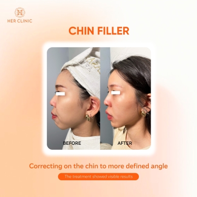 Chin Filler