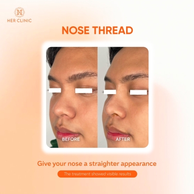 Nose Thread