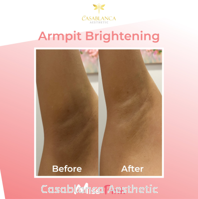 Armpit Whitening