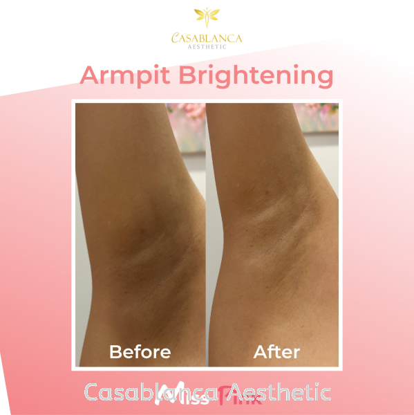 Armpit Whitening MissPink Whitening  Kuala Lumpur (KL), Malaysia, Selangor, Ampang, Petaling Jaya (PJ) Services | CASABLANCA AESTHETIC