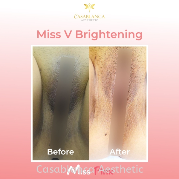 Vagina Whitening MissPink Whitening    Services | CASABLANCA AESTHETIC