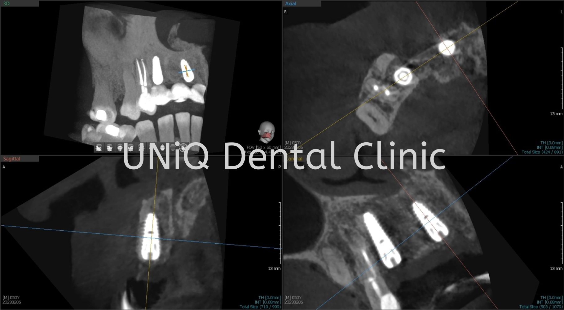 Tooth Implant