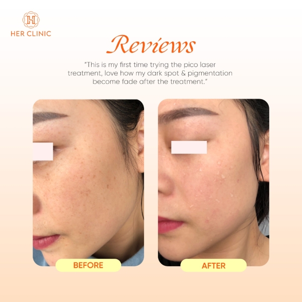 Picosecond Laser Picosecond Laser Selangor, Malaysia, Kuala Lumpur (KL), Petaling Jaya (PJ) Affordable Dermatologist, Body Shaping | CHUEN AESTHETIC SDN BHD