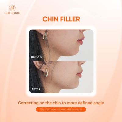 Chin Filler