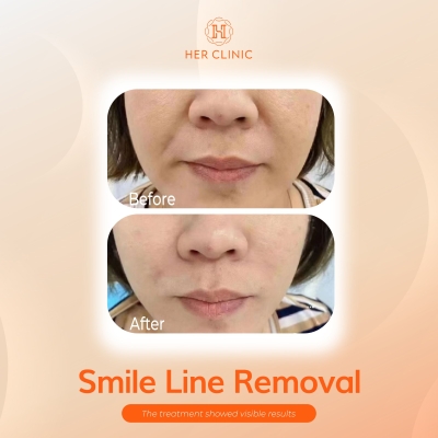 Smile Line Removal
