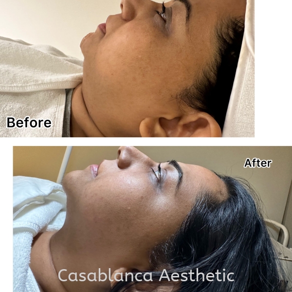 Slim Face Slim Face Kuala Lumpur (KL), Malaysia, Selangor, Ampang, Petaling Jaya (PJ) Services | CASABLANCA AESTHETIC