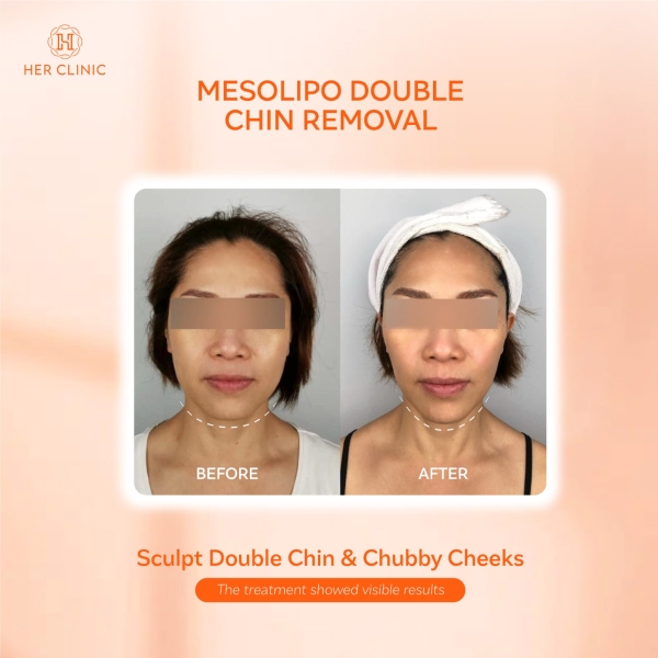 Double Chin Double Chin Removal Selangor, Malaysia, Kuala Lumpur (KL), Petaling Jaya (PJ) Affordable Dermatologist, Body Shaping | CHUEN AESTHETIC SDN BHD