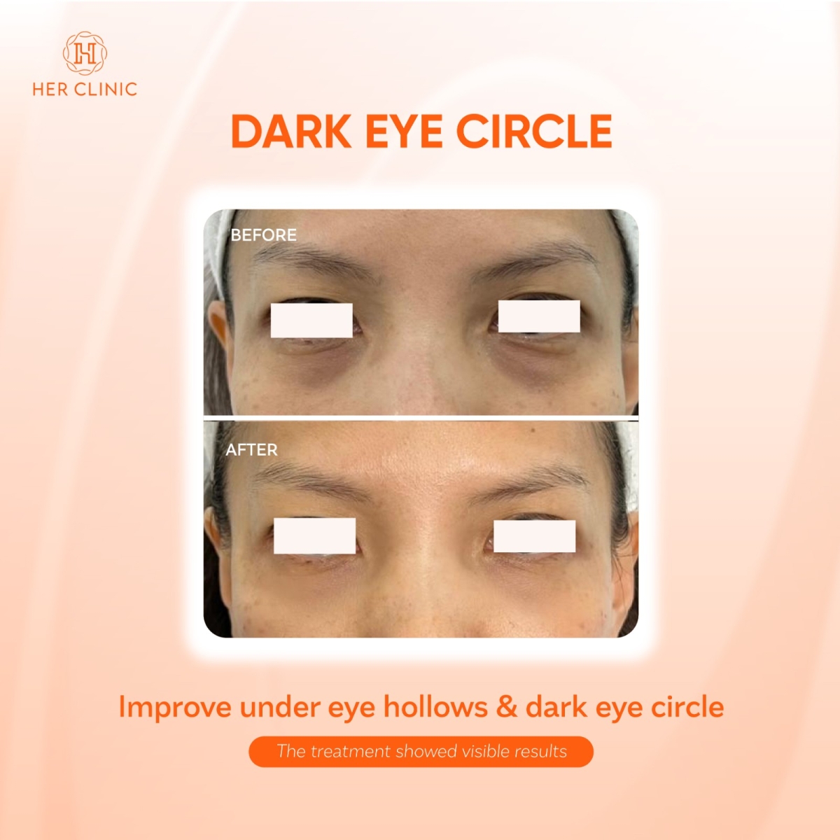 Dark Eye Circle Treatment At Kuala Lumpur & Petaling Jaya
