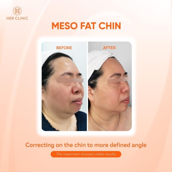 Double Chin Double Chin Removal Selangor, Malaysia, Kuala Lumpur (KL), Petaling Jaya (PJ) Affordable Dermatologist, Body Shaping | CHUEN AESTHETIC SDN BHD