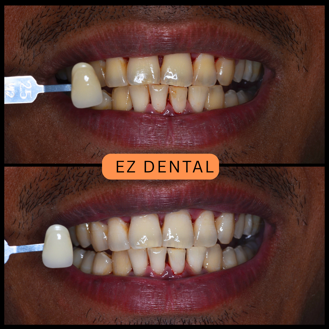 Teeth Whitening