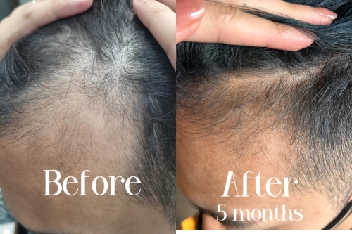 Anti-Hairfall Scalp Treatment