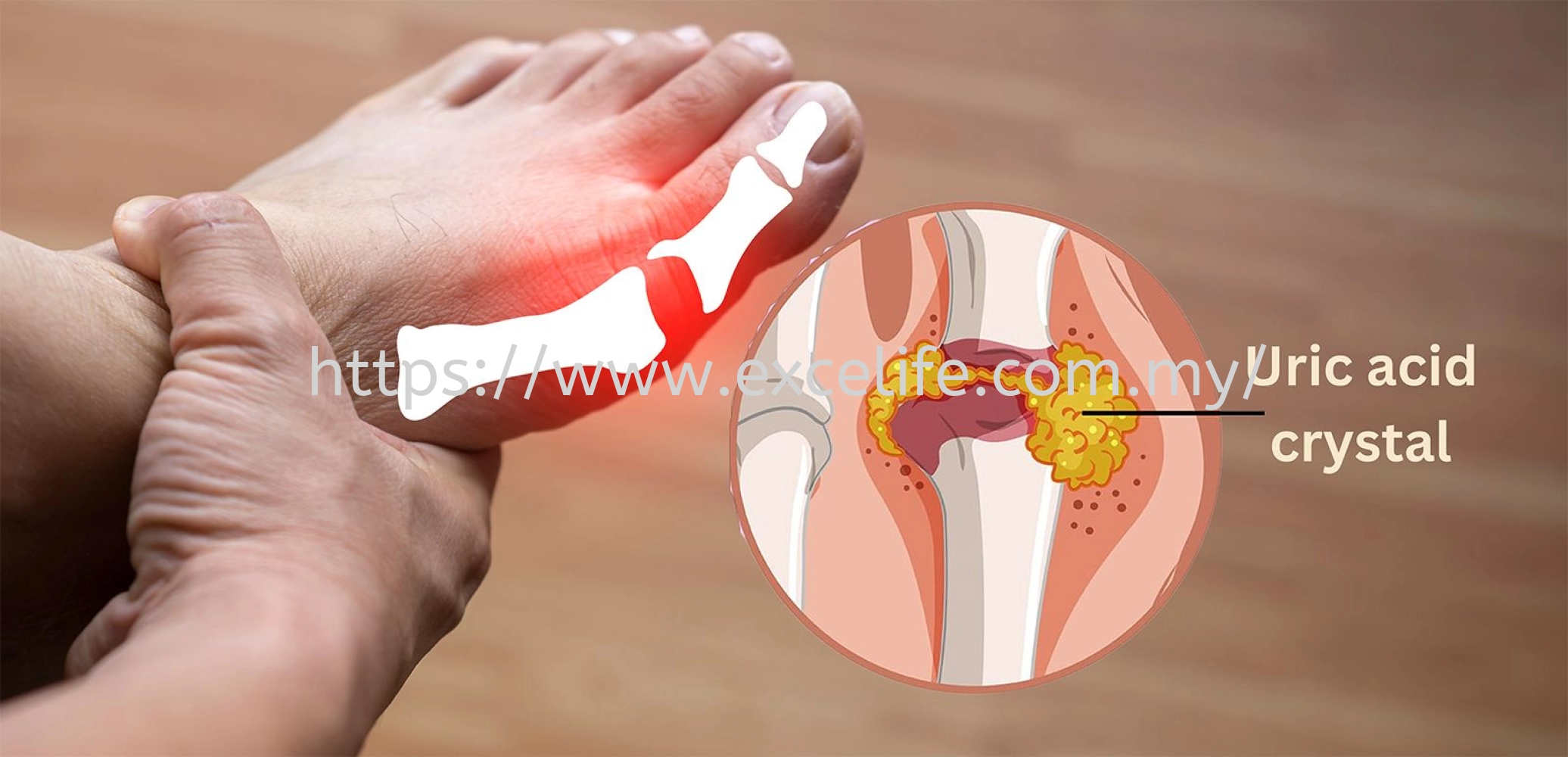 Do You Know That High Uric Acid May Indirectly Causing Gout and Kidney Disease?