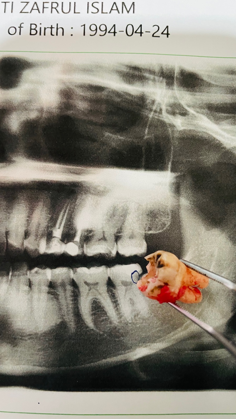 Minir Oral Surgery On 38