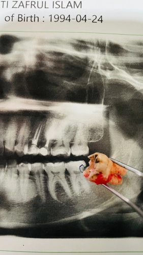 Minir Oral Surgery On 38