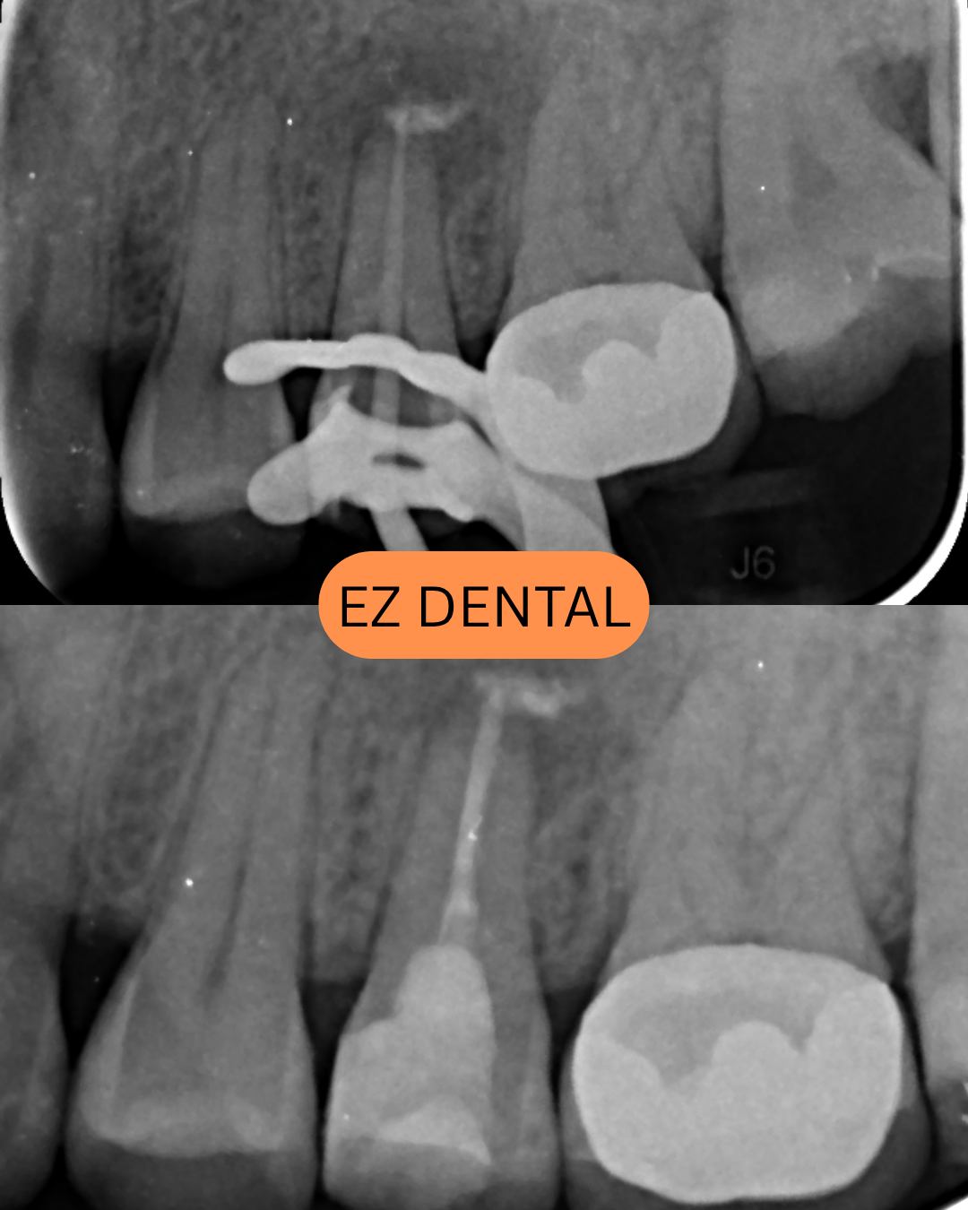 Root Canal Treatment