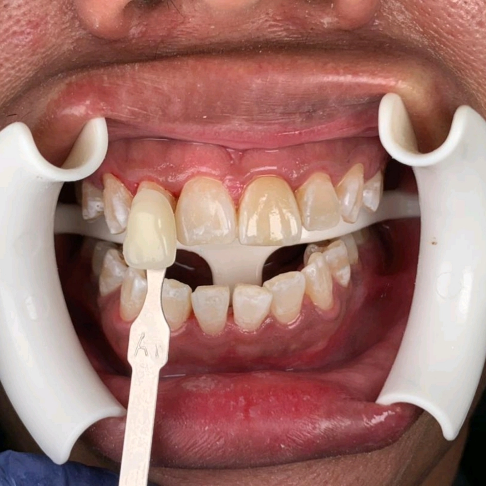 Normal Whitening 3 Cycle