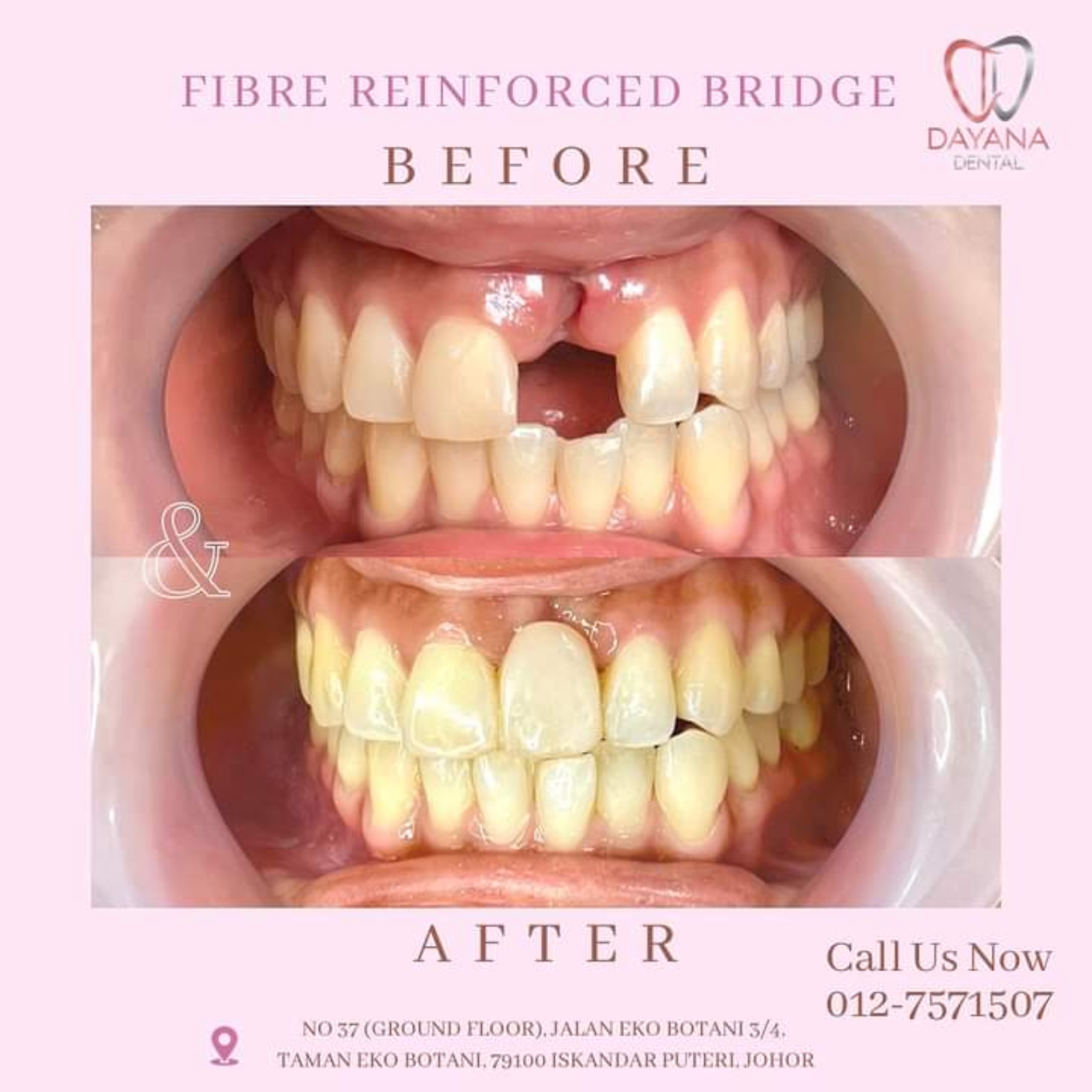 Fibre Reinforced Bridge