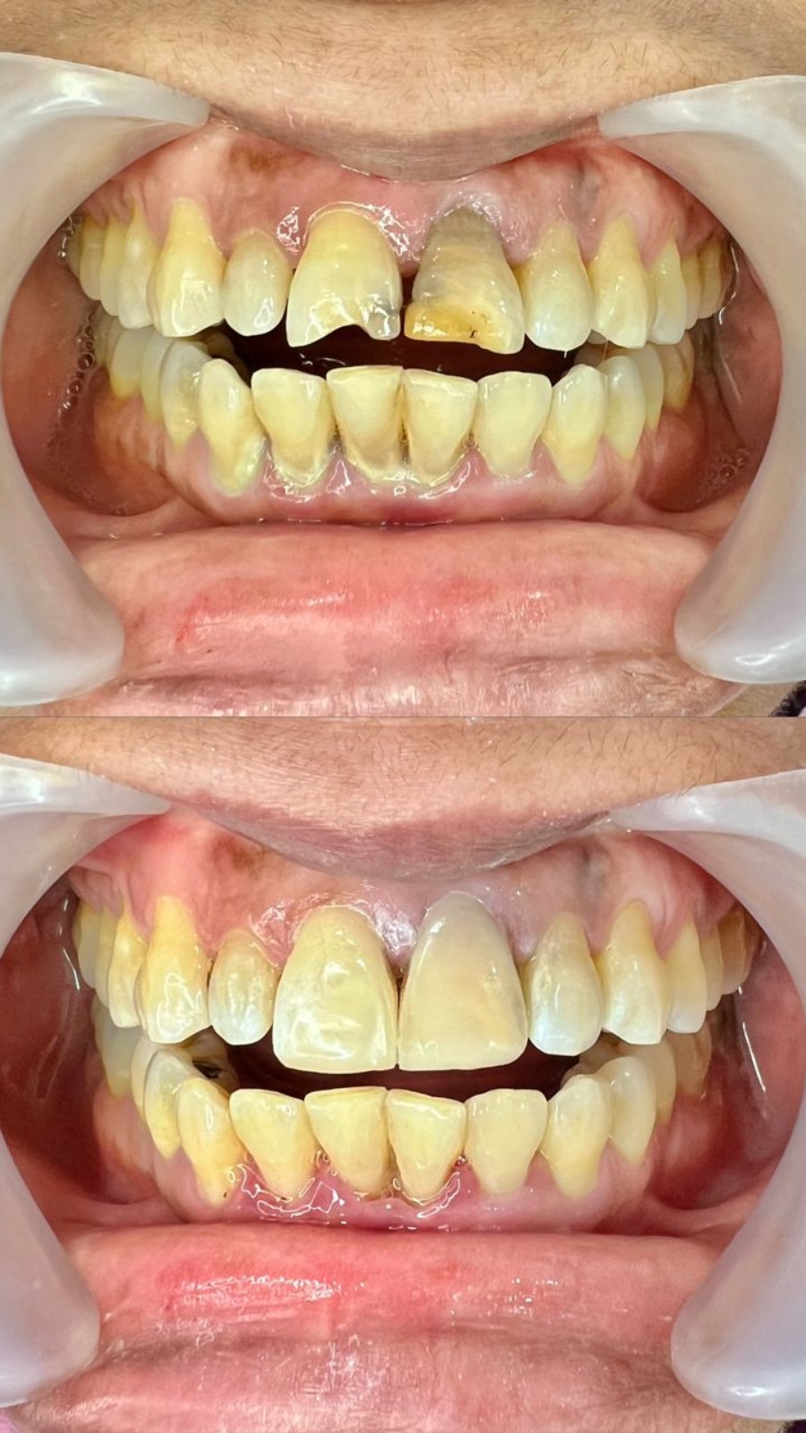 Composite Veneers