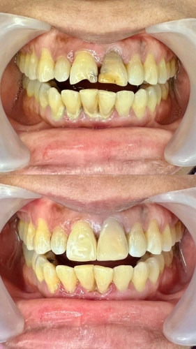 Composite Veneers