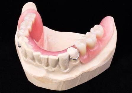 Partial Denture