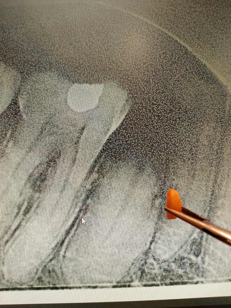 Surgical Extraction Root 