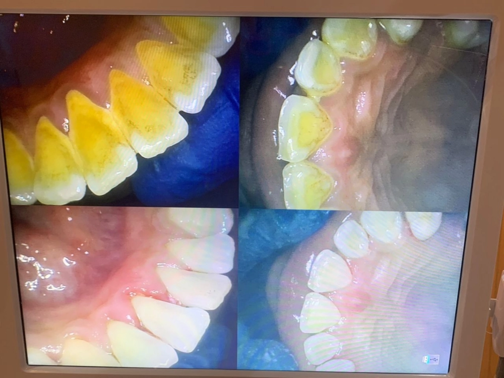 SCALING AND POLISHING 