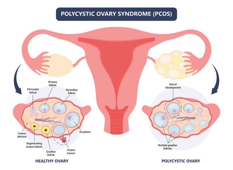 New Treatments for Polycystic Ovary Syndrome (PCOS)