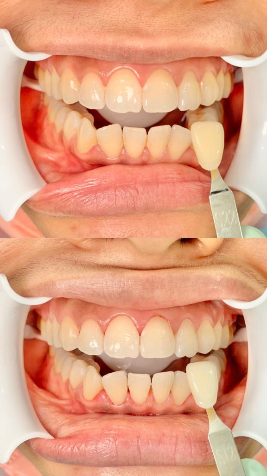 Whitening Dental Treatment