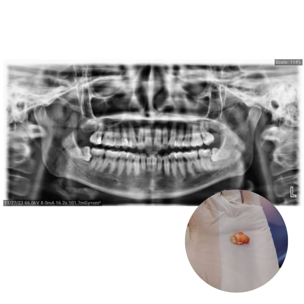 Wisdom Tooth Surgical Extraction 