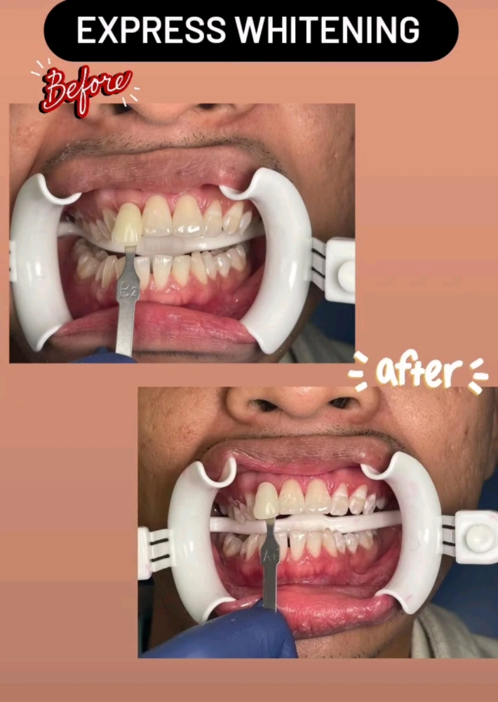 Express whitening 