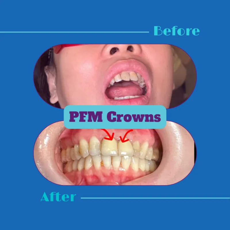 Unlocking Your Smile's Potential: A Comprehensive Guide to Dental Crowns