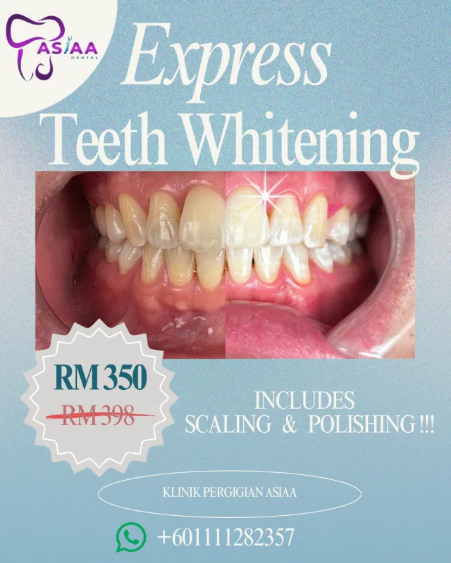 Express Teeth Whitening