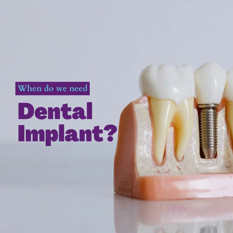 Restore Your Smile and Confidence with Dental Implants in Johor Bahru