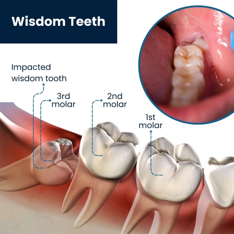 Is My Wisdom Tooth Coming In? Signs, Symptoms, and When to See a Dentist in Johor Bahru