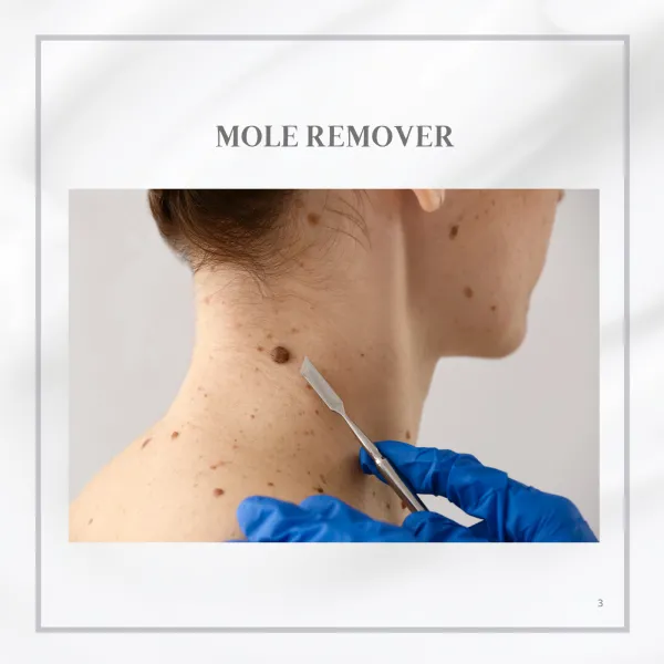 MOLE REMOVER / Menghilangkan tahi lalat yang tidak sedap dipandang atau timbul /Meningkatkan penampilan kosmetik