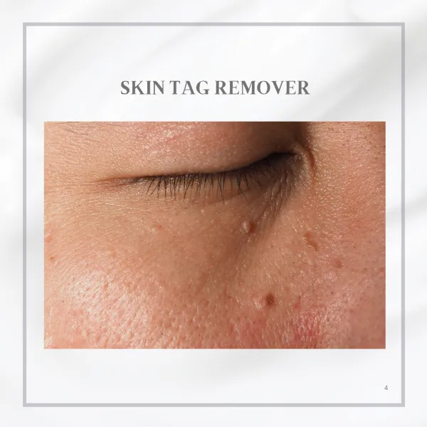 SKIN TAG REMOVER /Mengurangkan kerengsaan yang disebabkan oleh geseran /Mencegah luka atau jangkitan yang tidak disengajakan