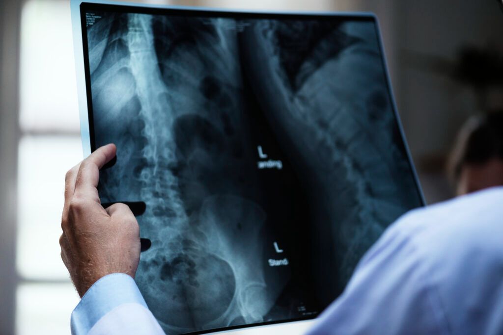 Spinal Scoliosis
