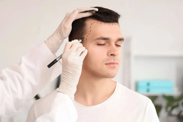 HAIR TRANSPLANT (Surgical Hair Restoration Procedure)
