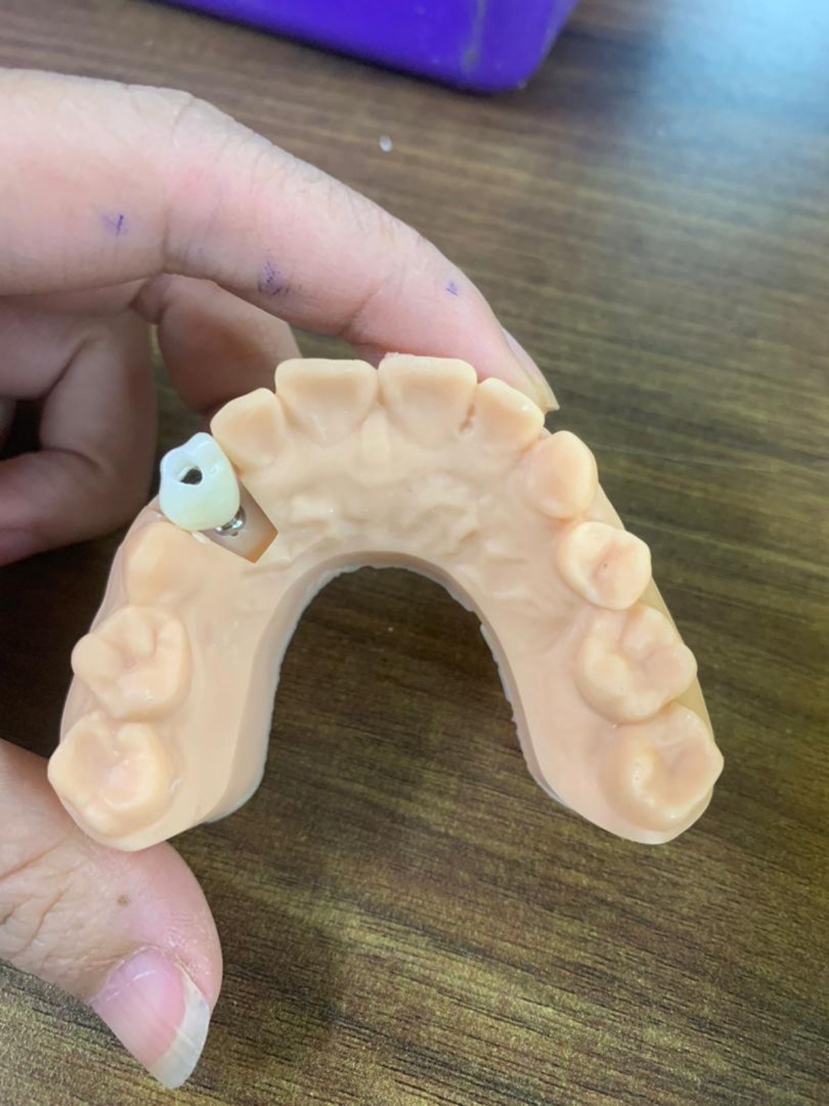 Dental Implant