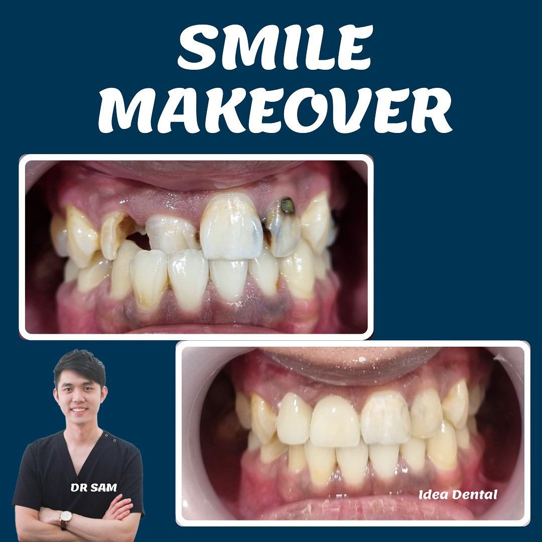Smile Makeover Before and After: What to Expect