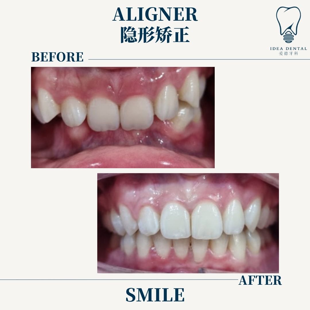 Who Is Suitable for Clear Aligner Treatment in Johor Bahru?