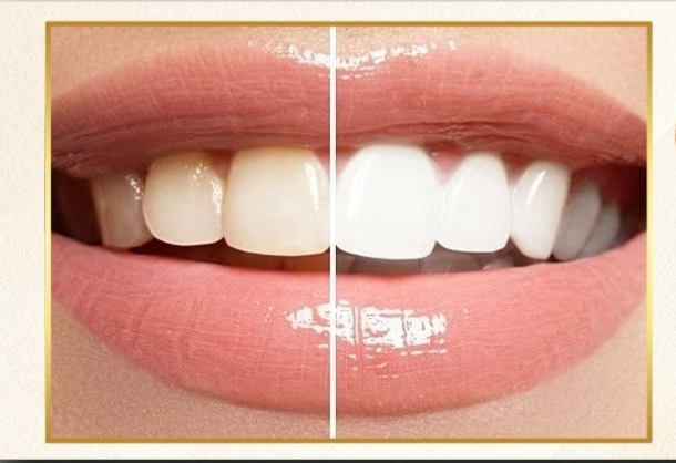 Is Teeth Whitening Safe? Dentist Guide