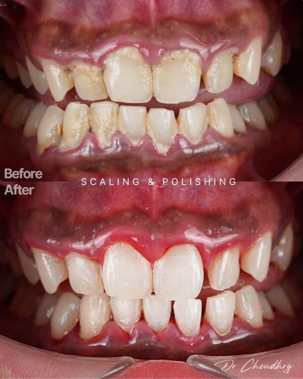 SCALING & POLISHING 