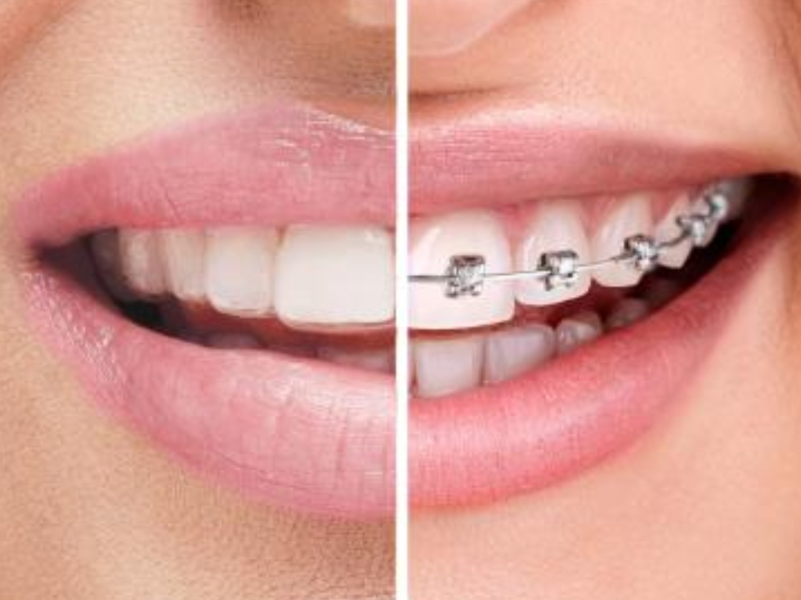 Braces Price in Johor Bahru 2026 | Cost of Braces JB Guide