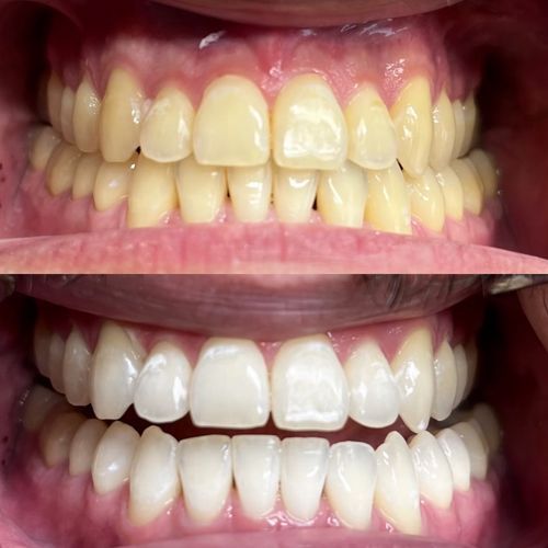 How Much Does Teeth Whitening Cost in JB? (Johor Bahru Price Guide)