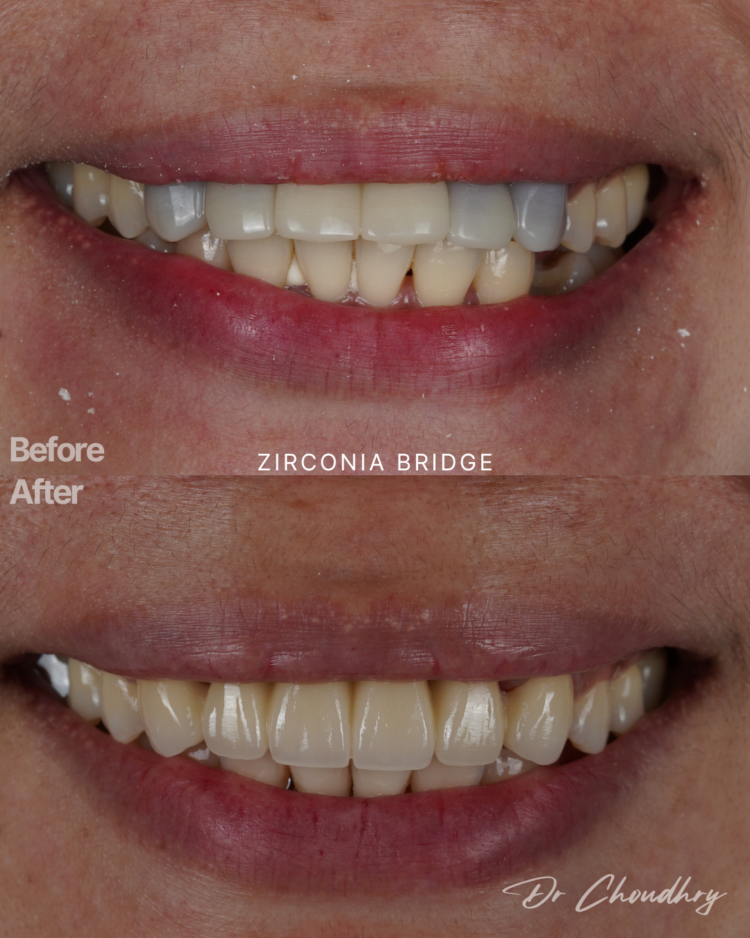 ZIRCONIA BRIDGE 