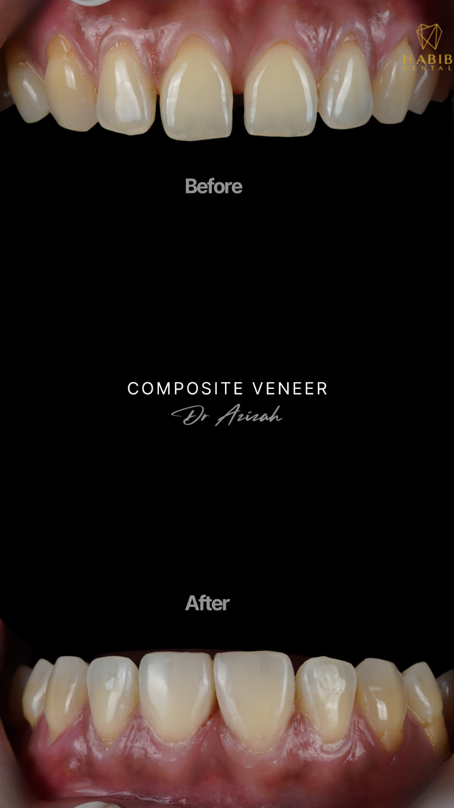 COMPOSITE VENEER 