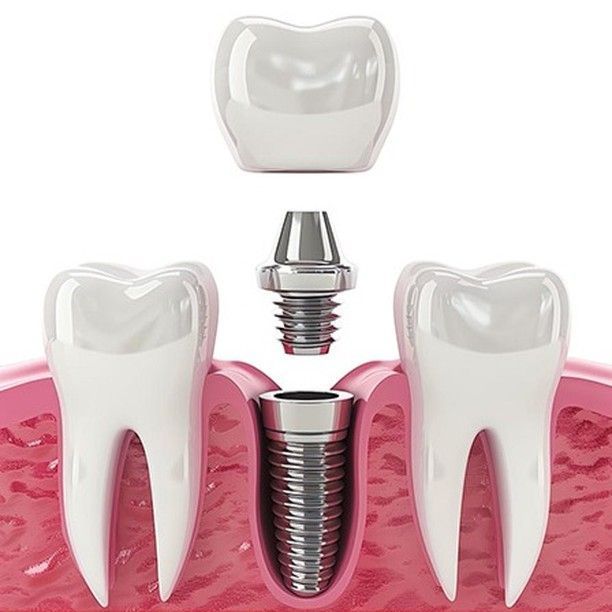 Is Dental Implant Painful? JB Dentist Explains
