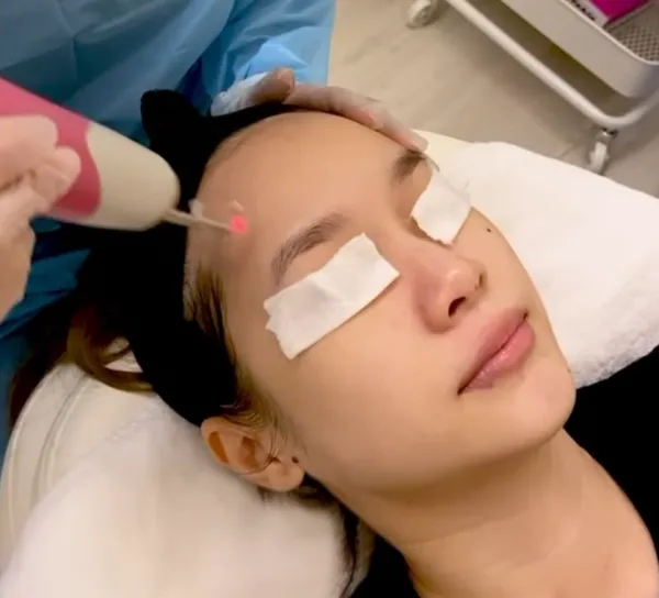 Pico Laser (Doctor‑Performed)