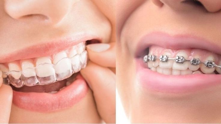 How Long Do Braces Take in Johor Bahru? A Complete Guide (2026)